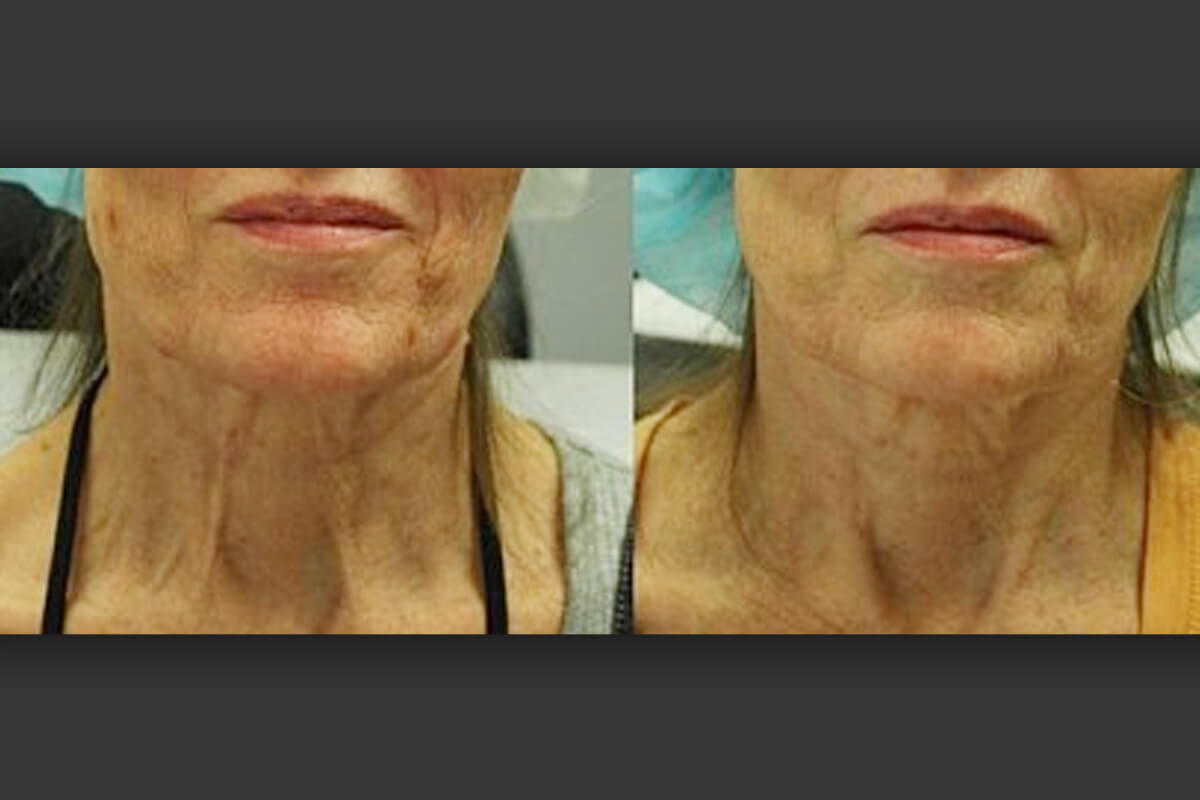 Микроигольчатый RF-лифтинг Morpheus 8 01