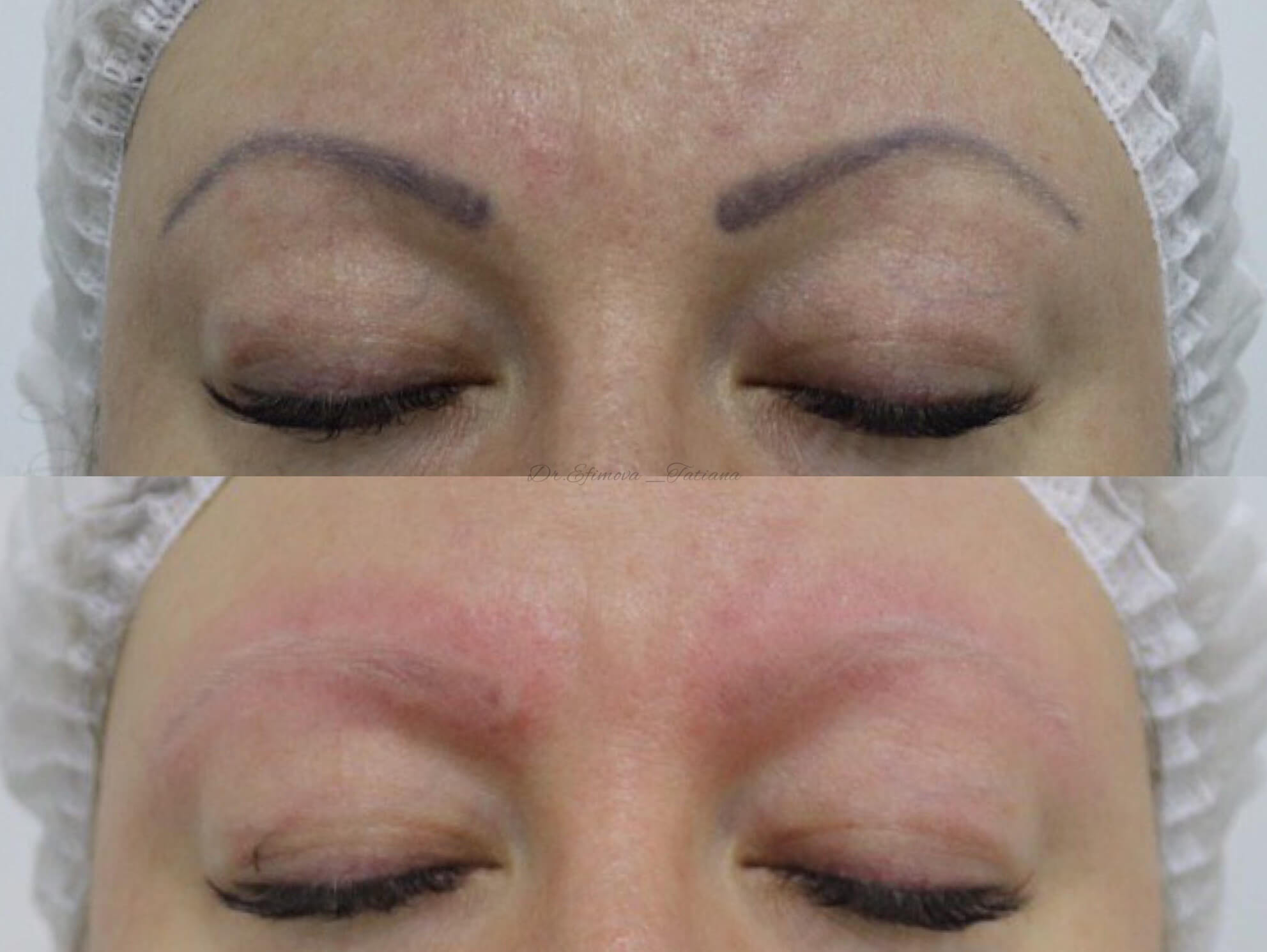 Удаление татуажа PicoSure 01