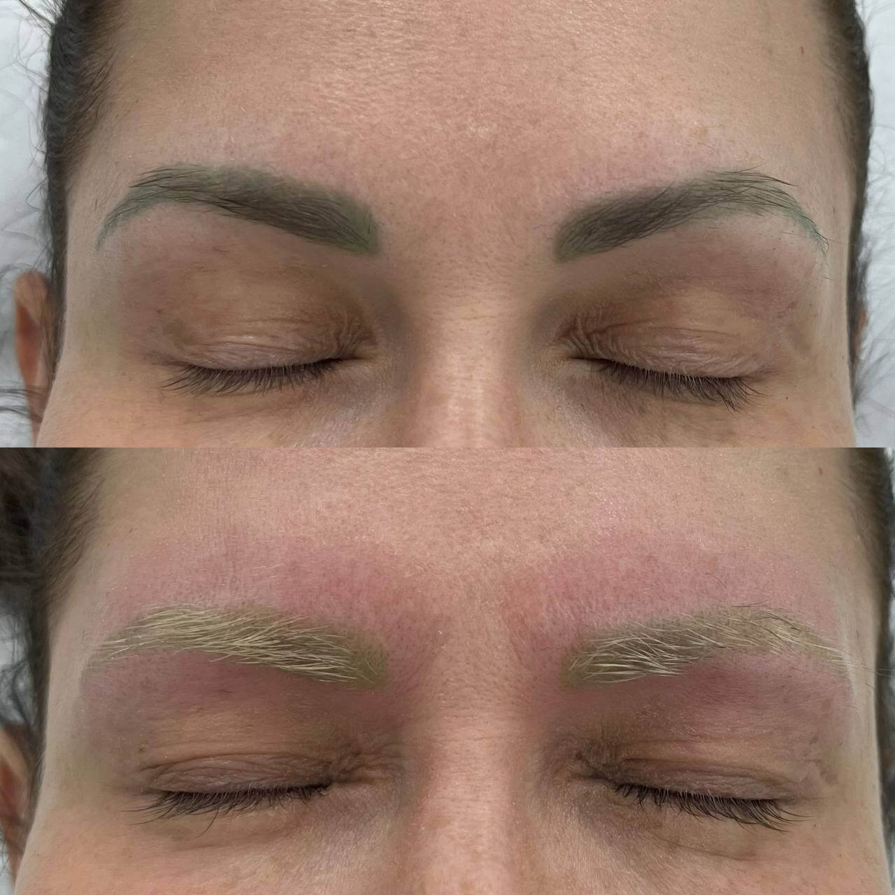 Удаление татуажа PicoSure 01