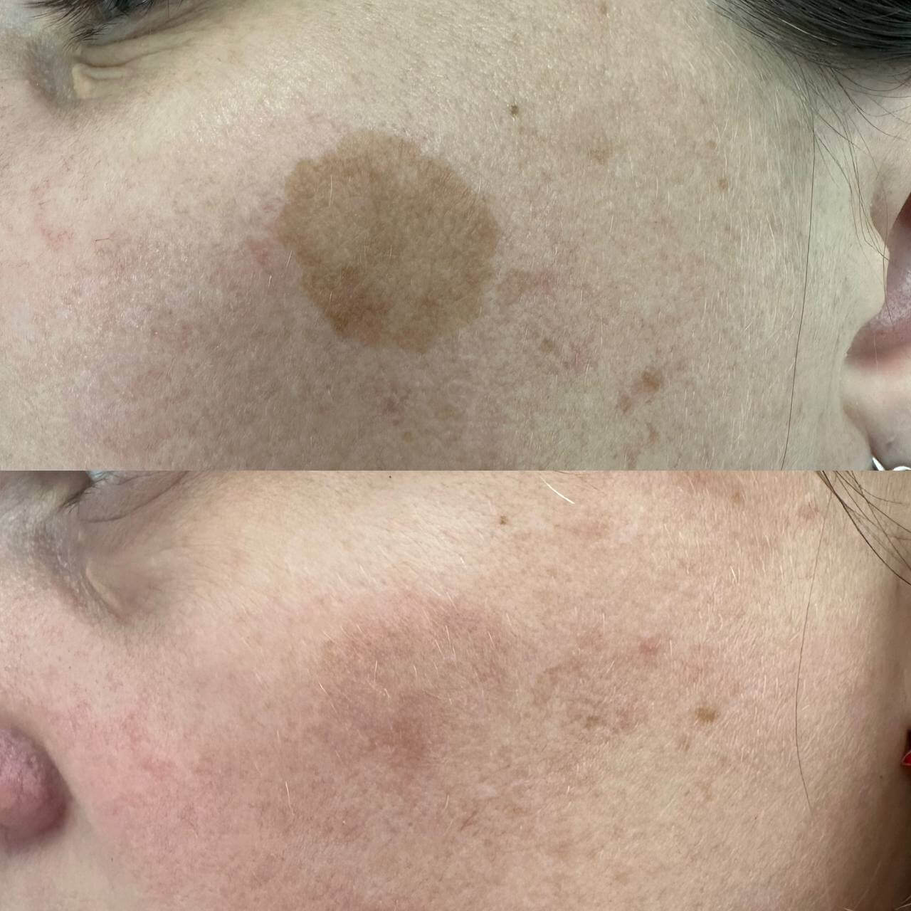 Удаление пигментации PicoSure 01