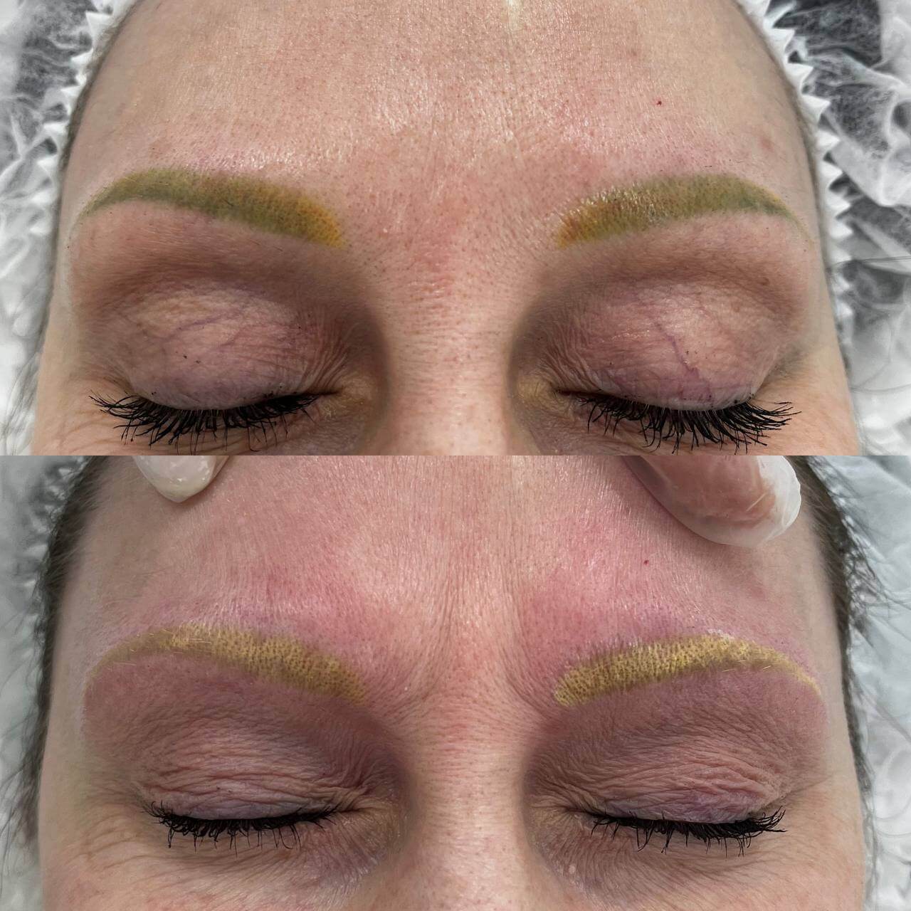 Удаление татуажа PicoSure 01