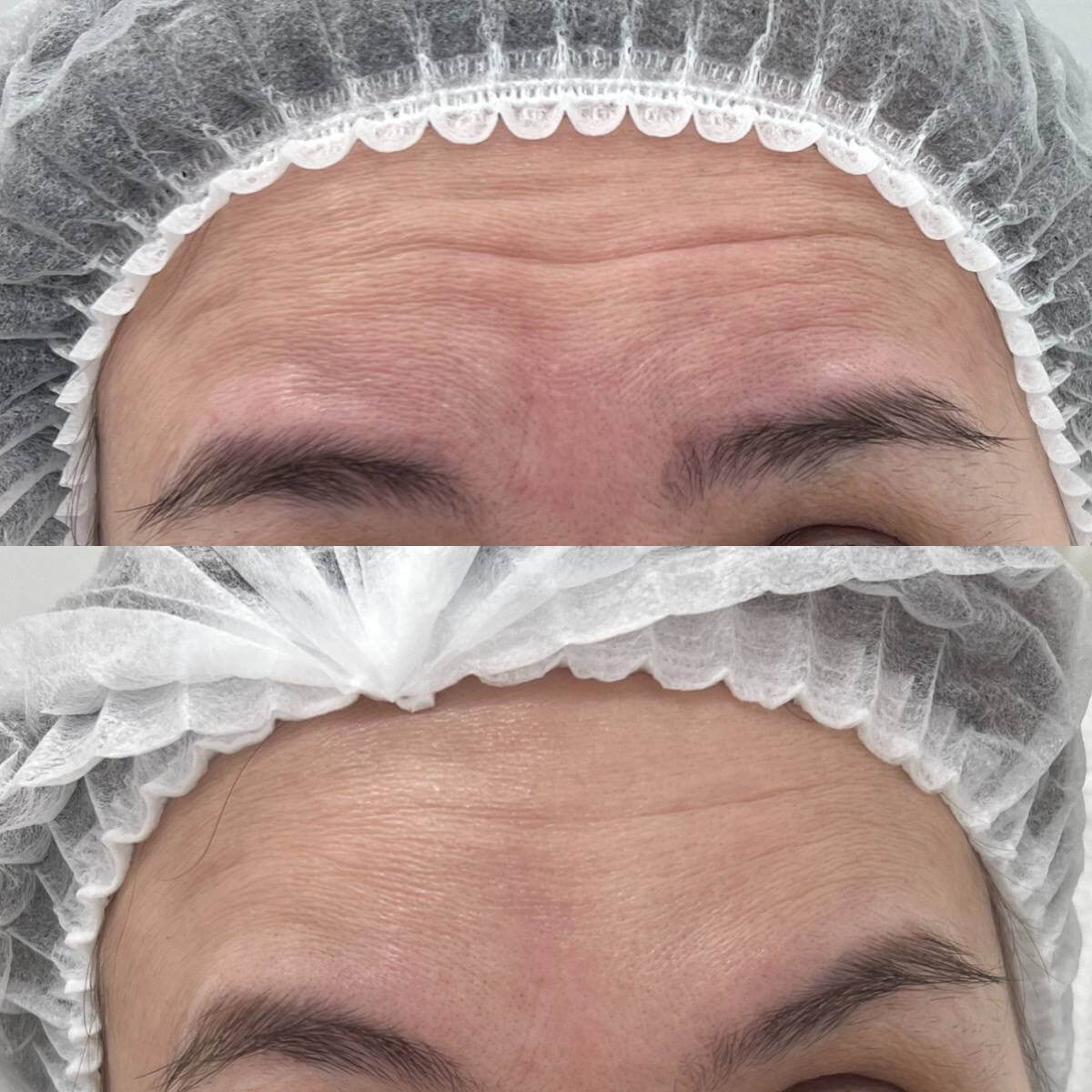 Ботулинотерапия 01