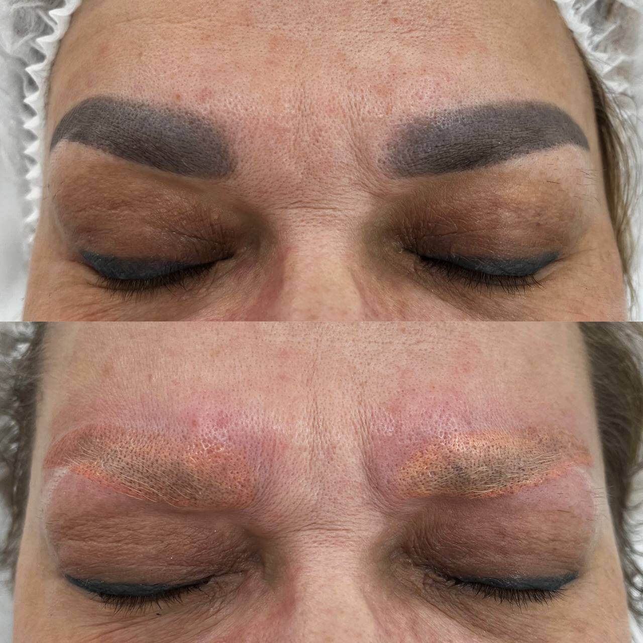 Удаление татуажа PicoSure 01