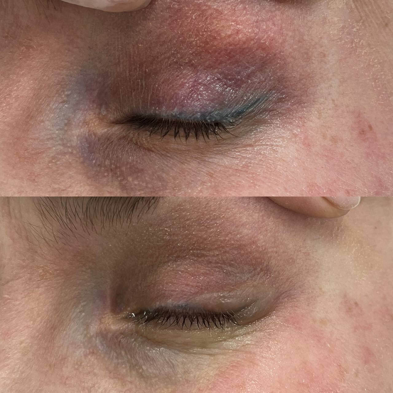 Удаление татуажа PicoSure 01