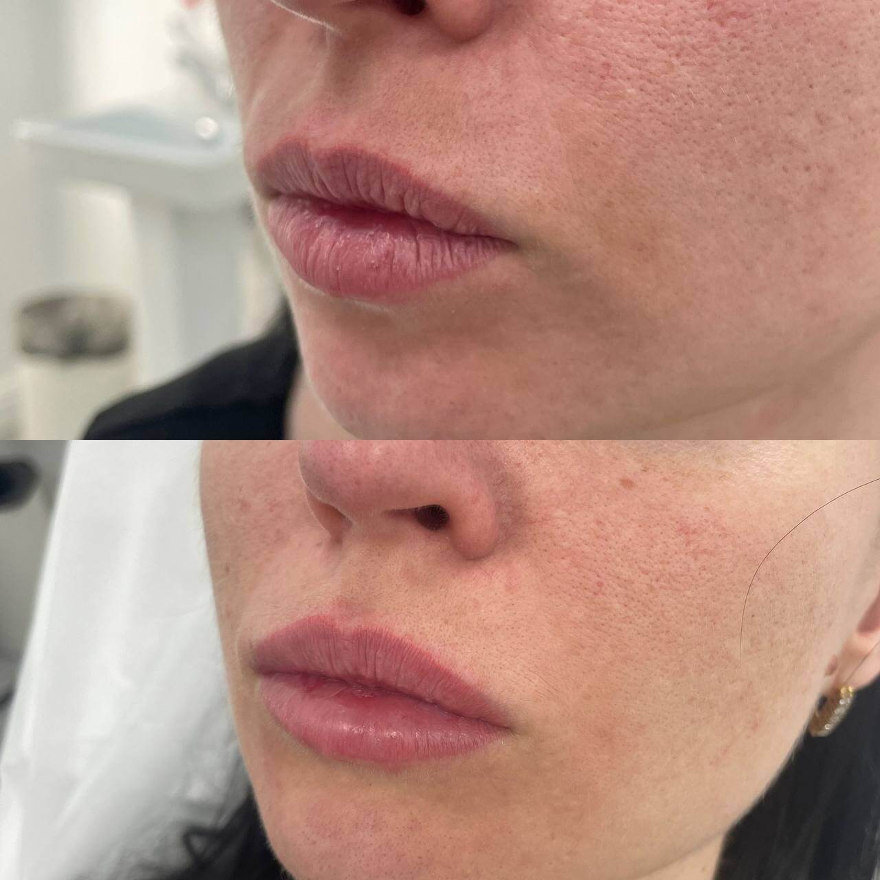 Увеличение губ 01