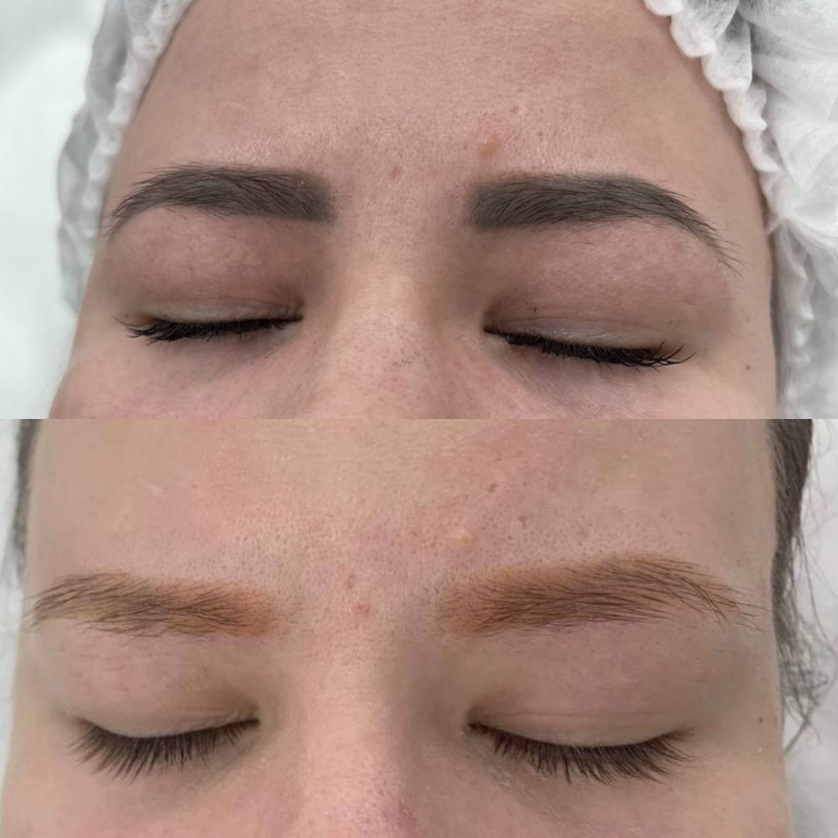 Удаление татуажа PicoSure 01