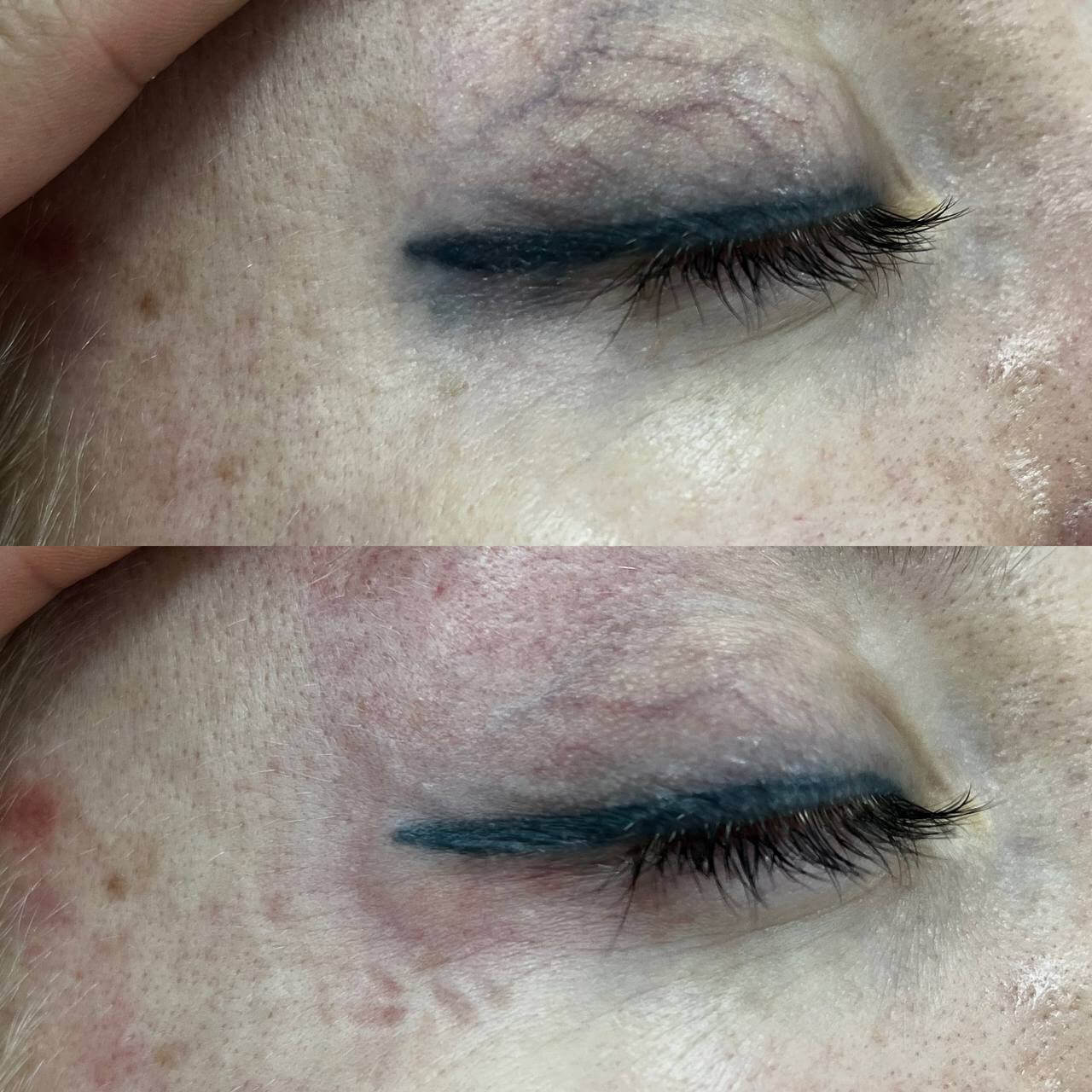 Удаление татуажа PicoSure 01