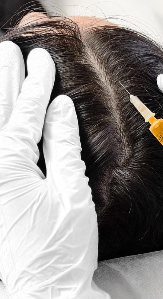 Плазмолифтинг (плазмотерапия)