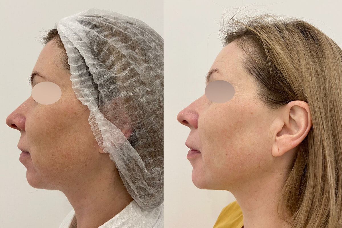 Филлер Радиесс (Radiesse) 01