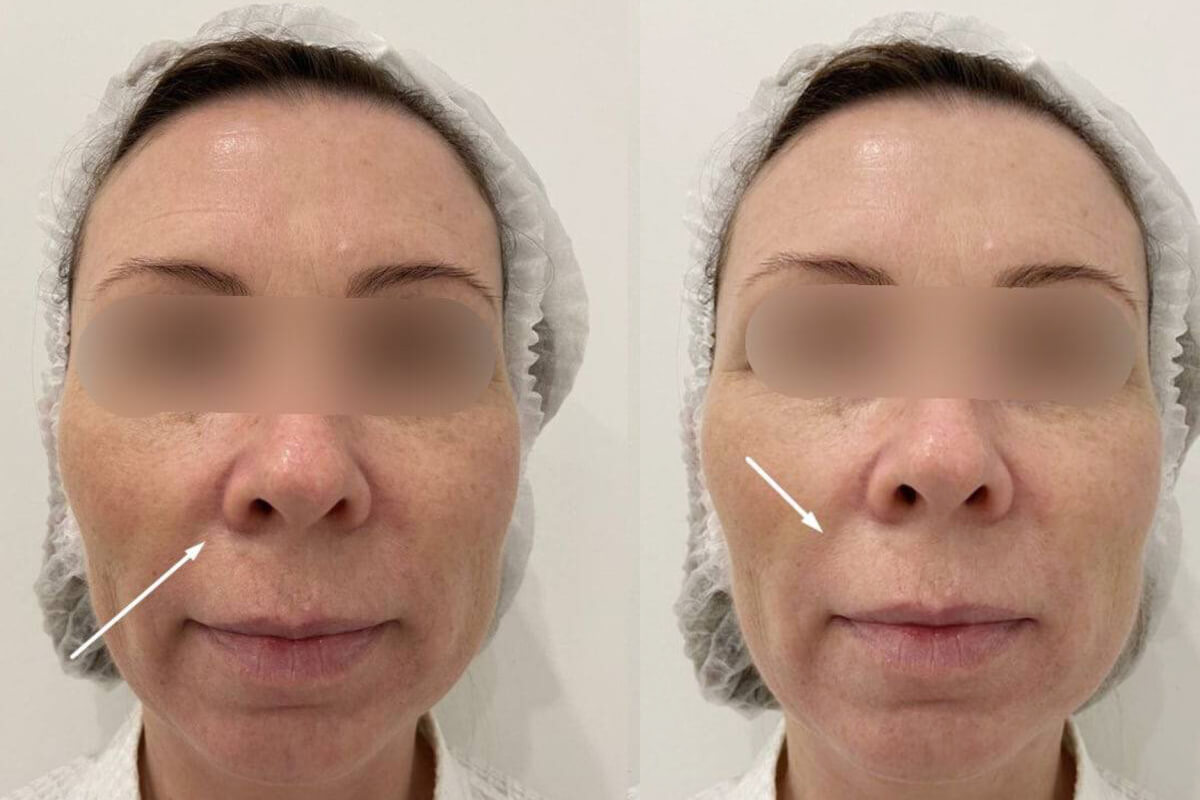 Филлер Радиесс (Radiesse) 01