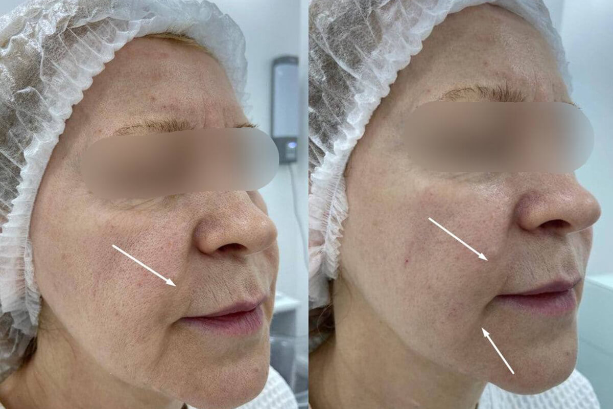 Филлер Радиесс (Radiesse) 01