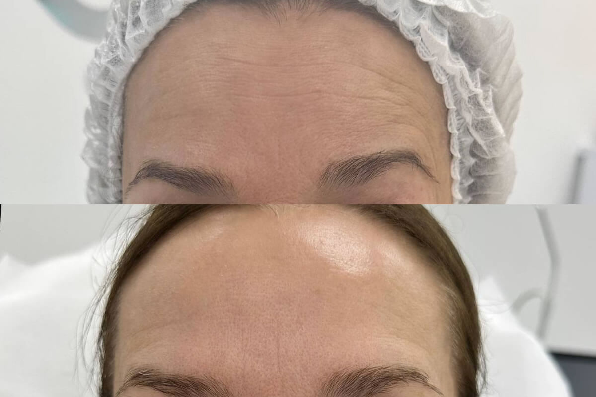 Ботулинотерапия 01