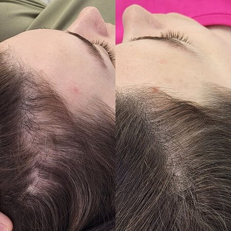 PRP-терапия 01