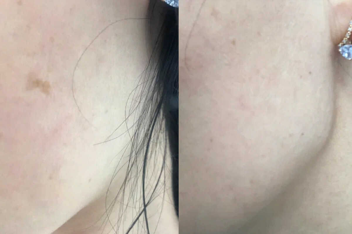 Удаление пигментных пятен 01