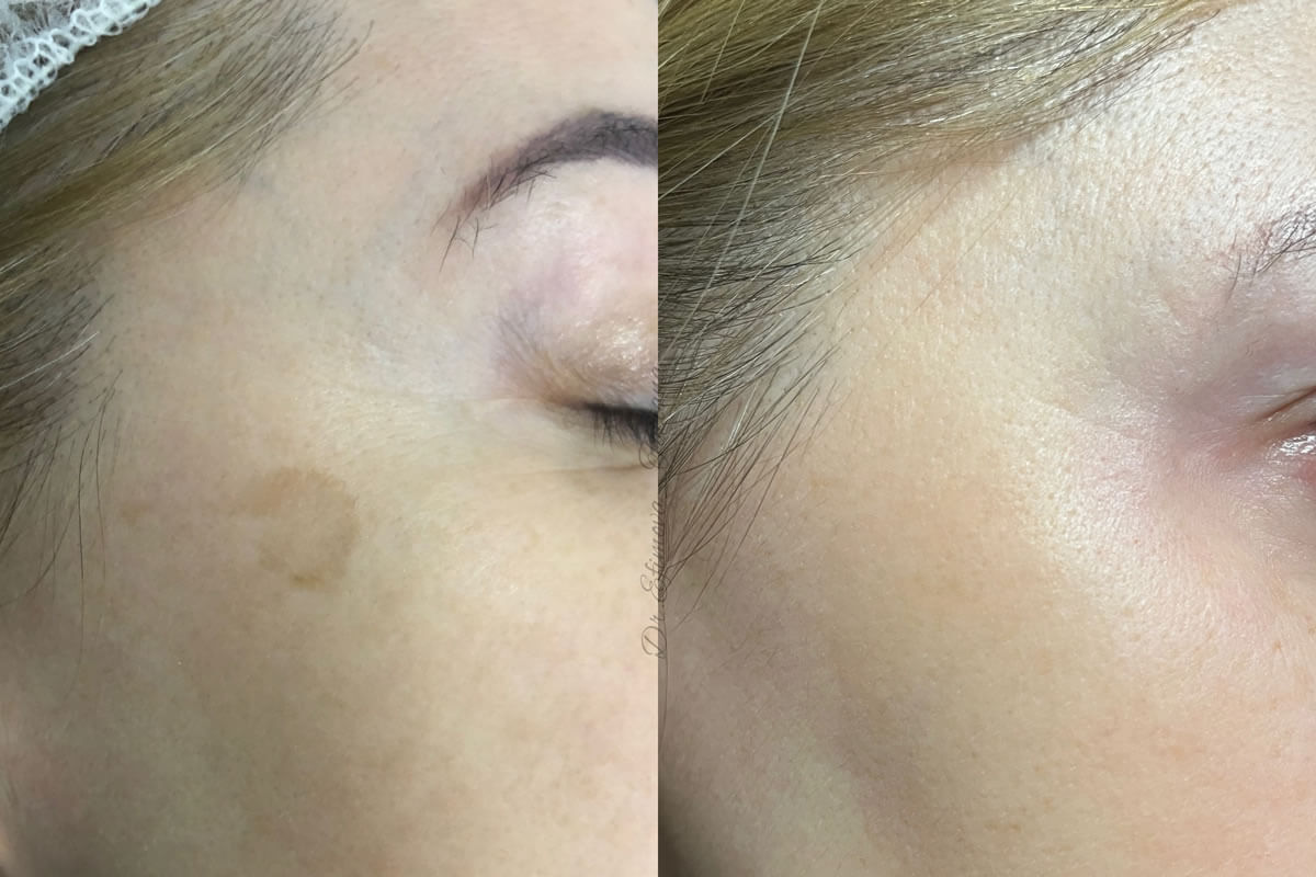 Удаление пигментных пятен 01