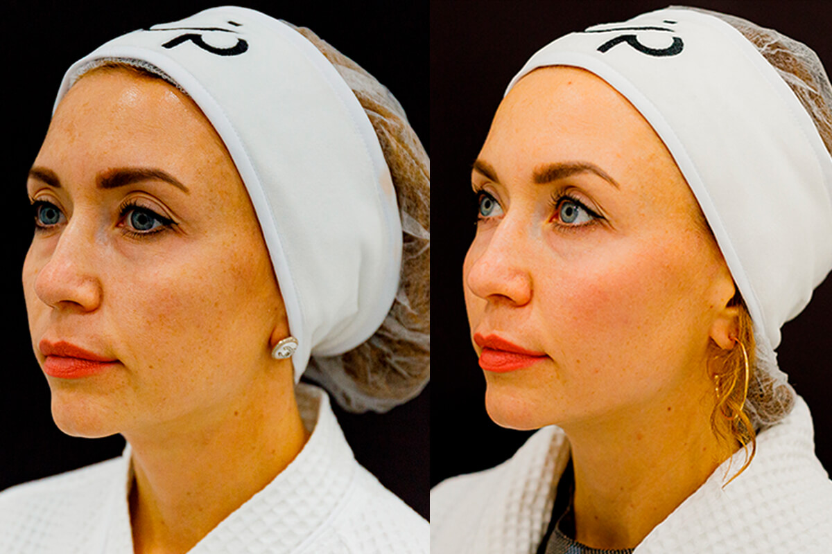 Лазерное омоложение лица PicoSure 01