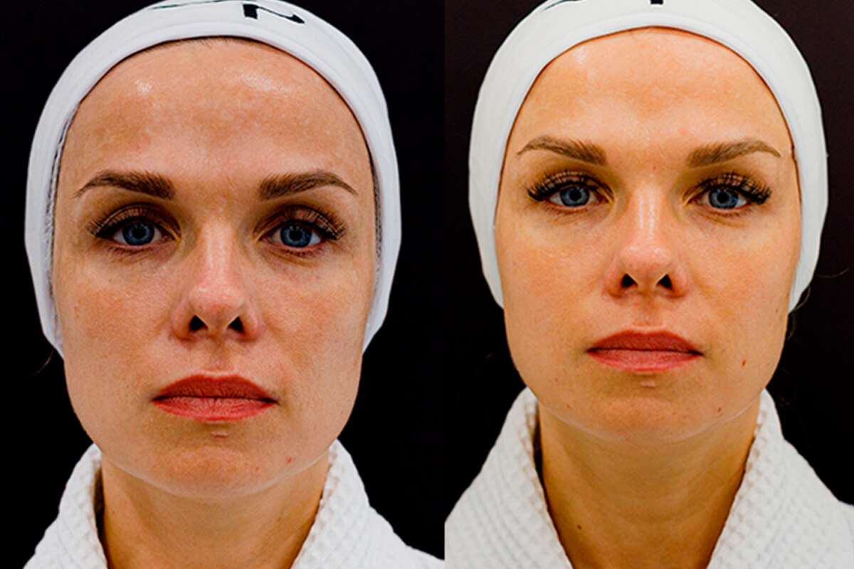 Удаление пигментных пятен 01