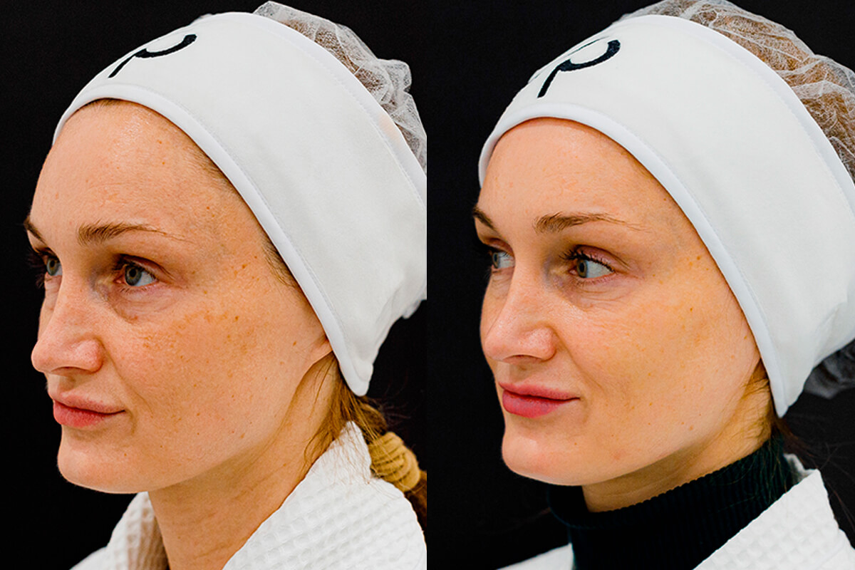 Удаление пигментации PicoSure 01