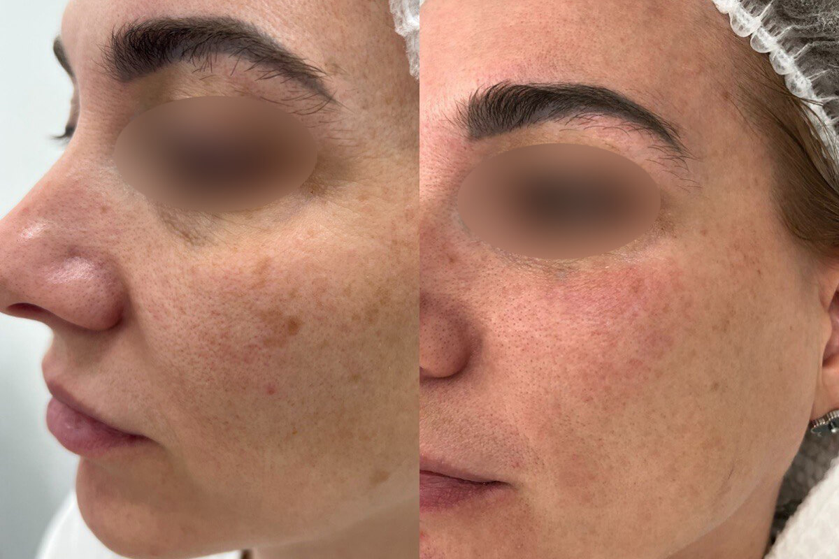 Удаление пигментации PicoSure 01