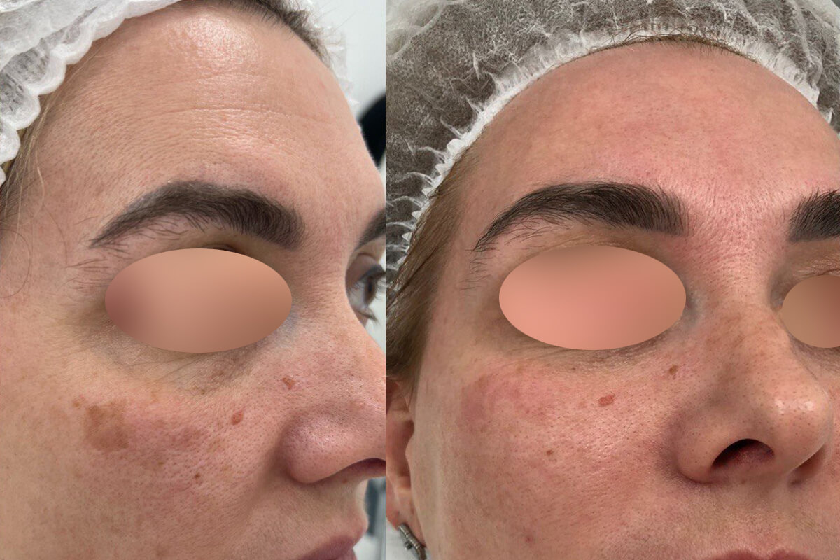 Удаление пигментации PicoSure 01