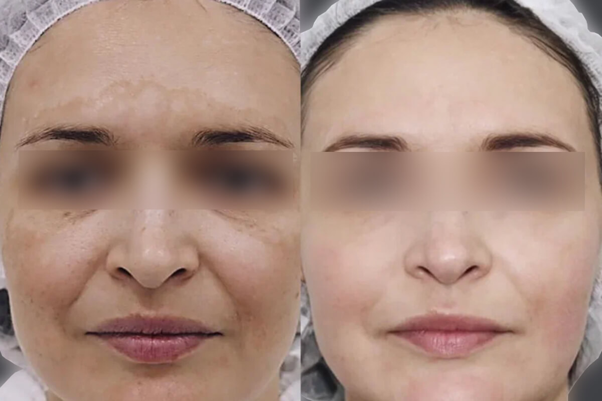 Удаление пигментных пятен 01