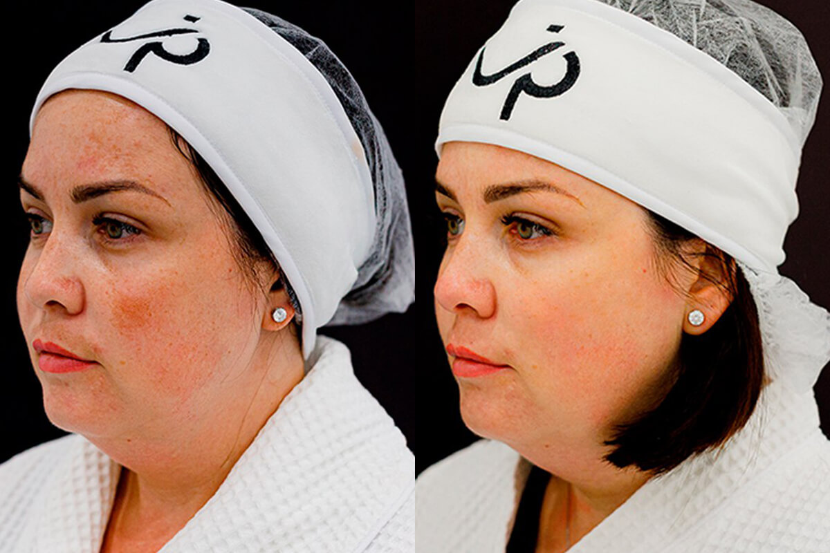 Удаление пигментации PicoSure 01