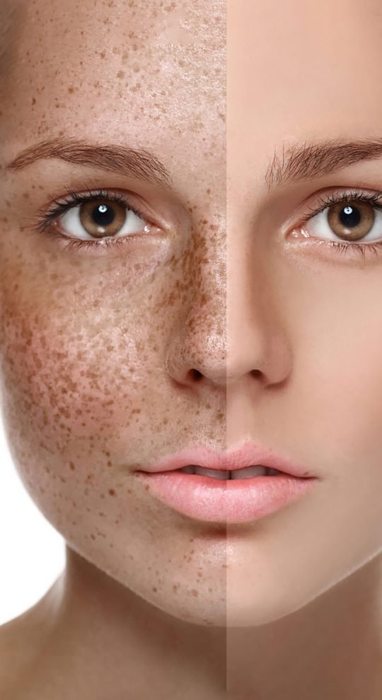 Удаление пигментации PicoSure