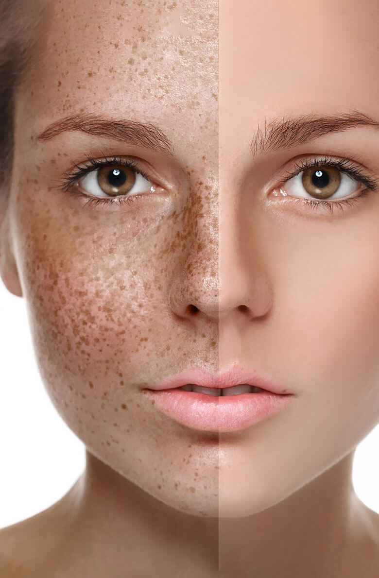 Удаление пигментации PicoSure