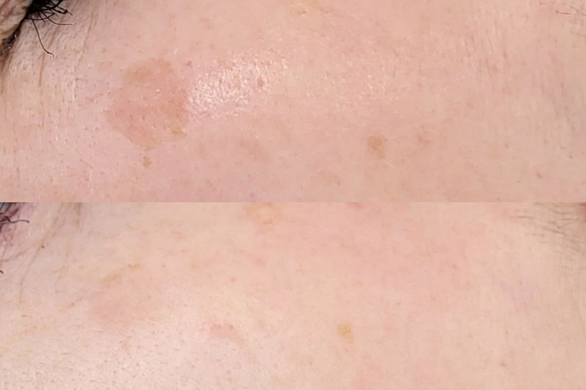 Удаление пигментации PicoSure 01