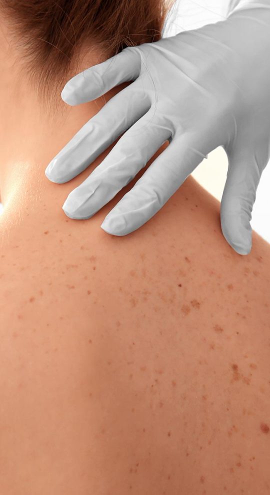 Удаление пигментных пятен