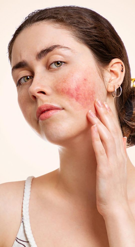 Удаление сосудистых звездочек М22