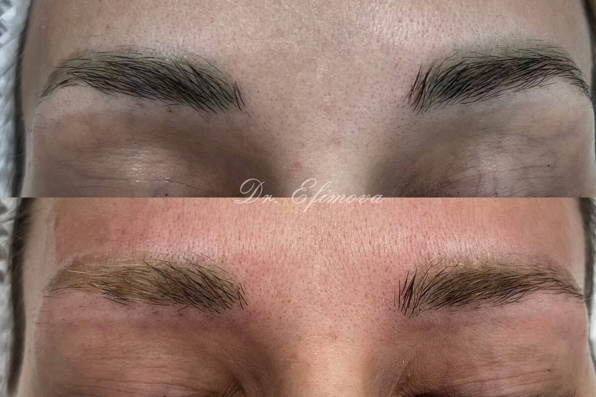 Удаление татуажа PicoSure 01