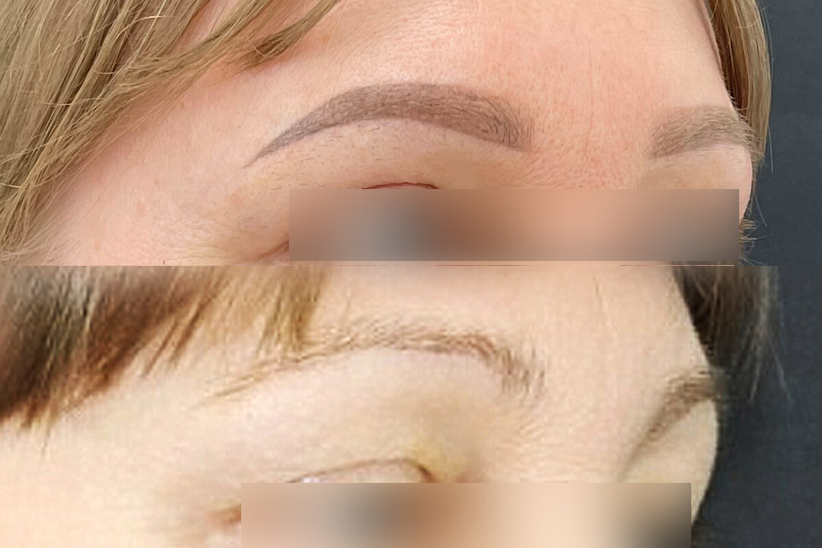 Удаление татуажа PicoSure 01