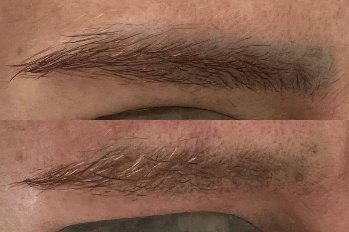 Удаление татуажа PicoSure 01