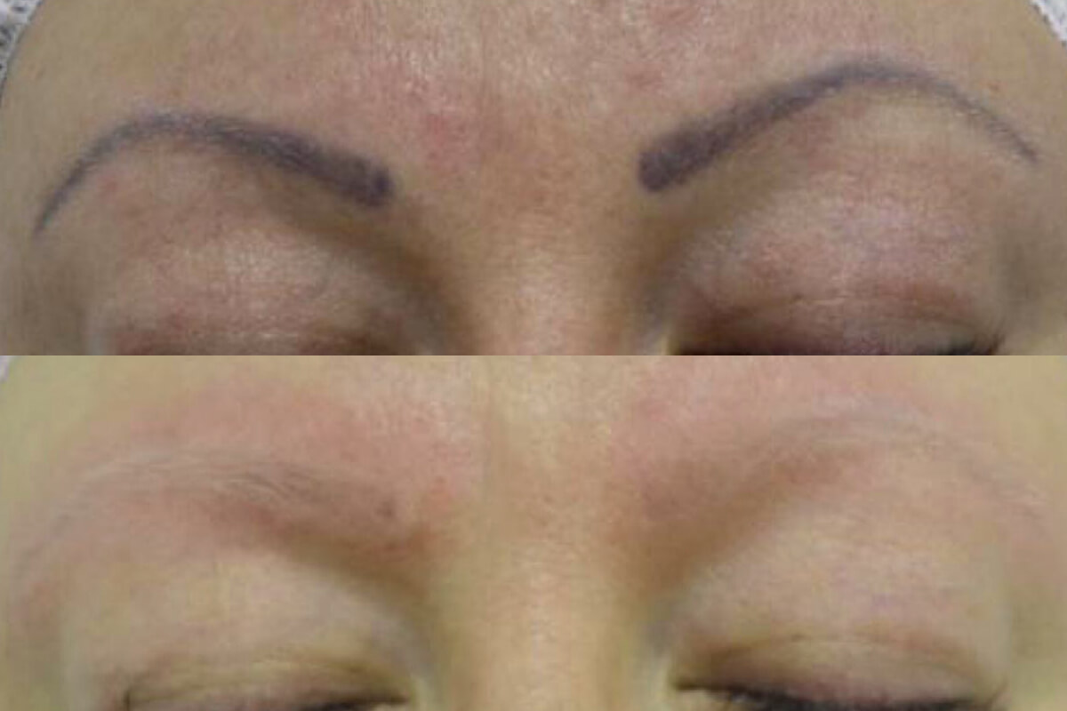 Удаление татуажа PicoSure 01