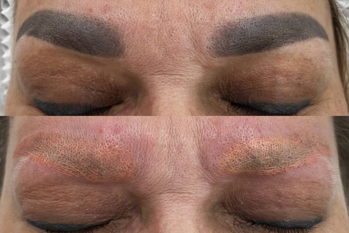 Удаление татуажа PicoSure 01