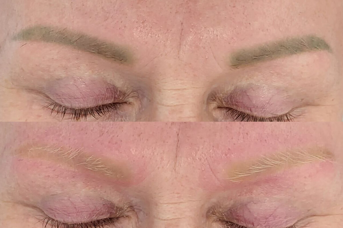 Удаление татуажа PicoSure 01