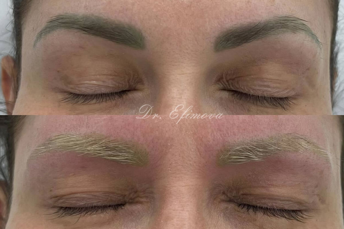 Удаление татуажа PicoSure 01