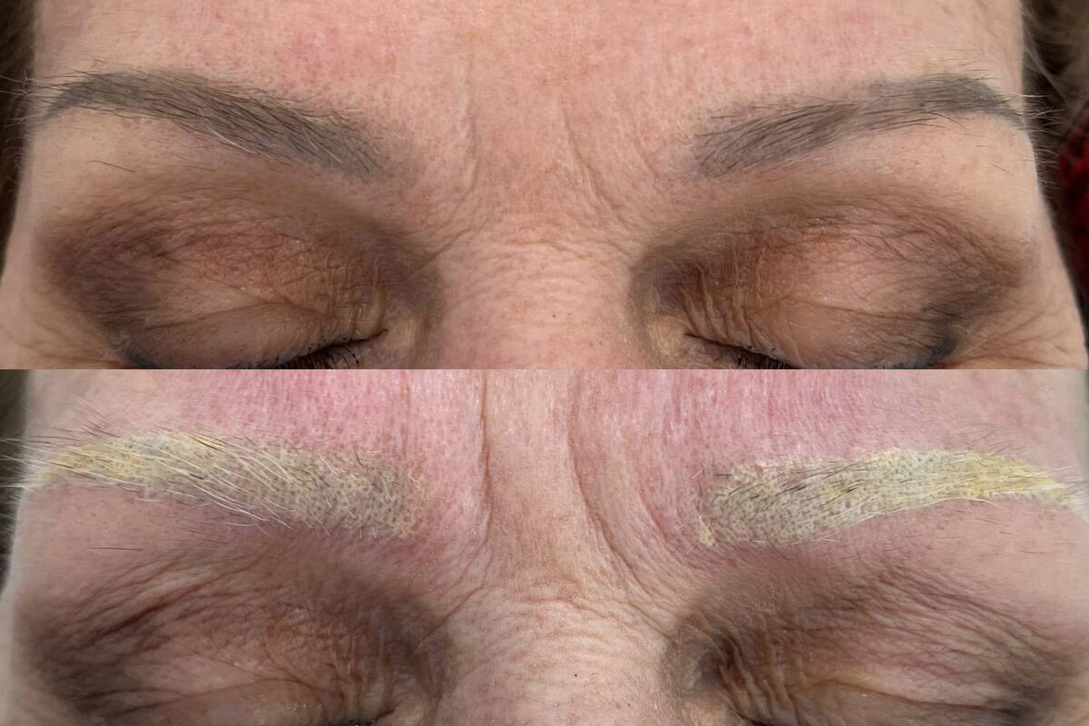 Удаление татуажа PicoSure 01