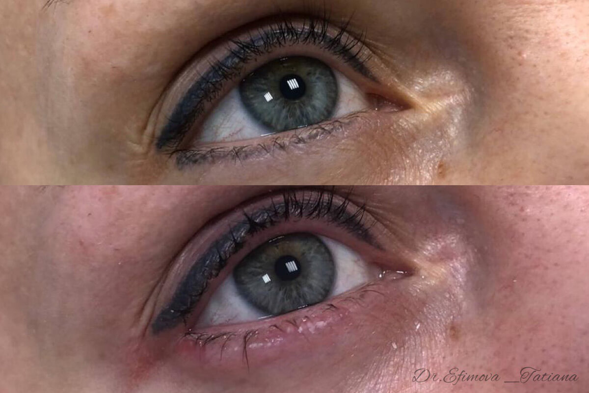 Удаление татуажа PicoSure 01