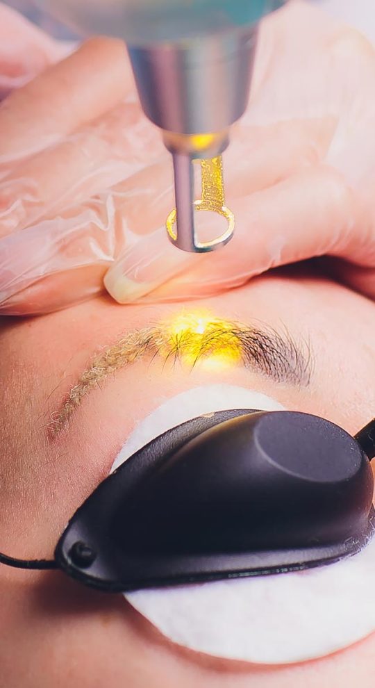 Удаление татуажа PicoSure