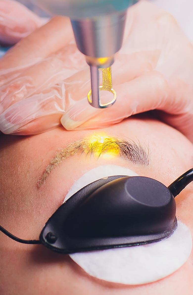 Удаление татуажа PicoSure