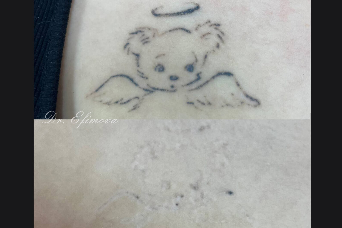 Удаление татуировок PicoSure 01