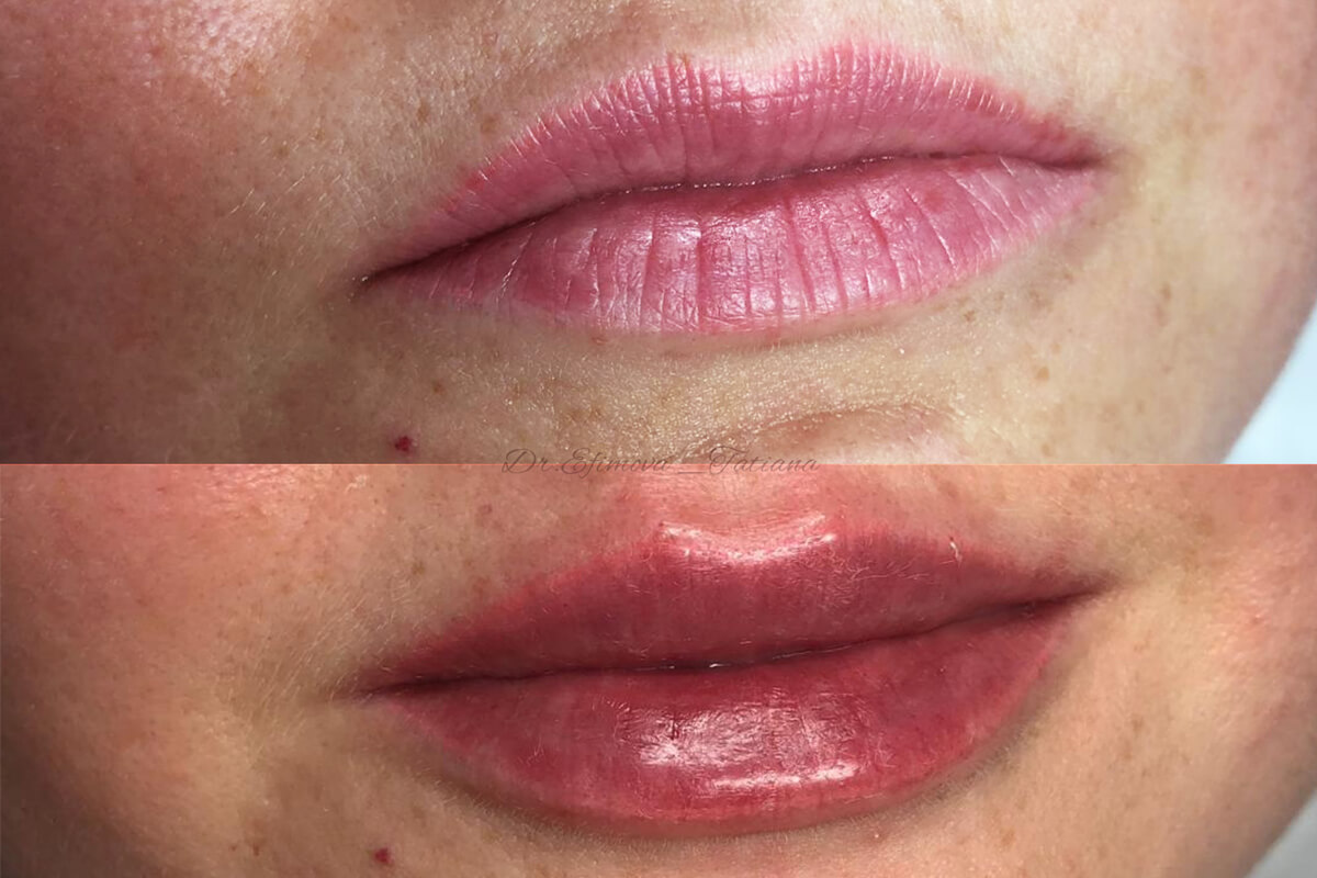 Увеличение губ 01