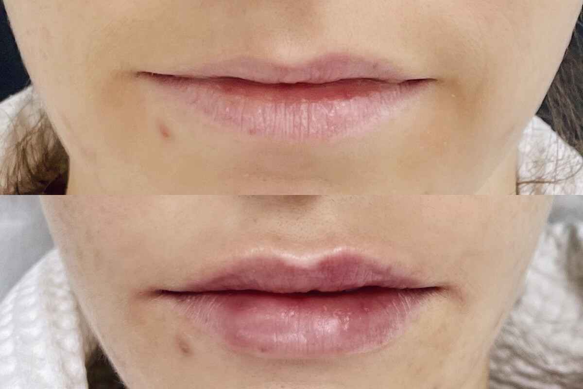 Увеличение губ 01