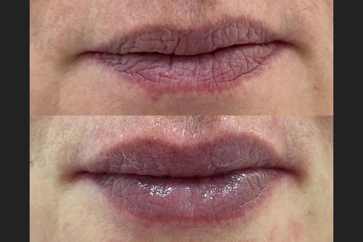 Увеличение губ 01