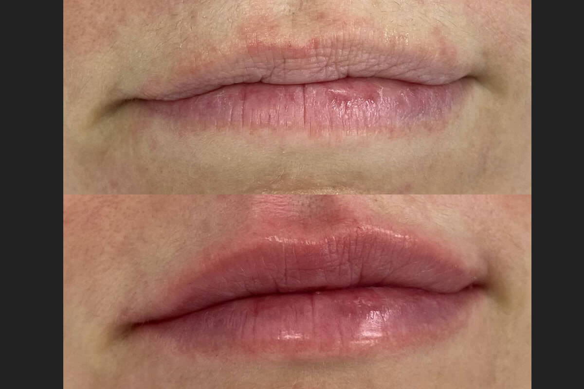 Увеличение губ 01