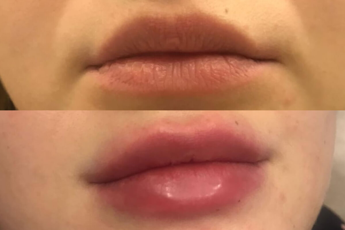 Увеличение губ 01