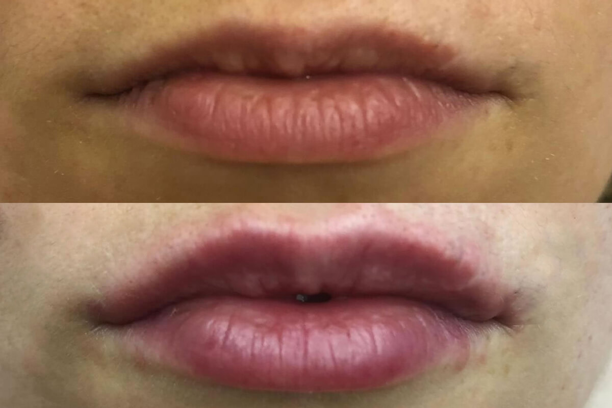 Увеличение губ 01