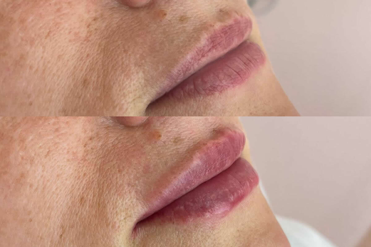 Увеличение губ 01